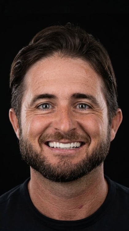 After veneers
