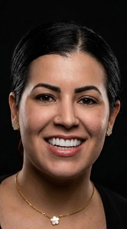 After veneers