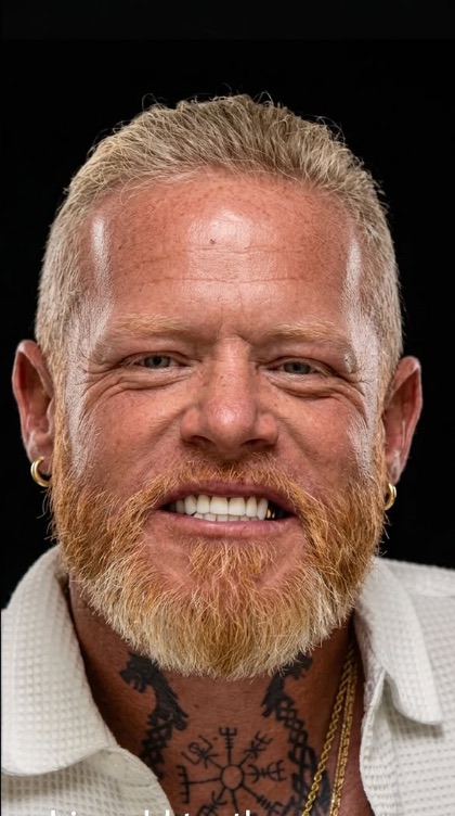 After veneers